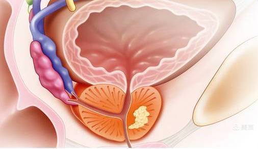 人体前列腺癌图片图片