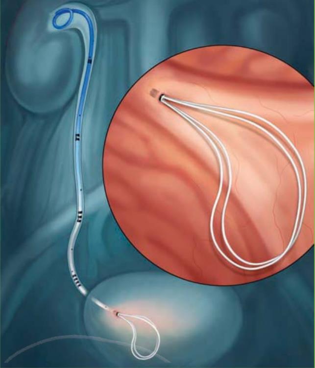 男性输尿管支架图片