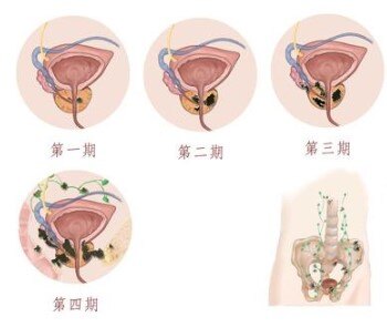 人体前列腺癌图片图片