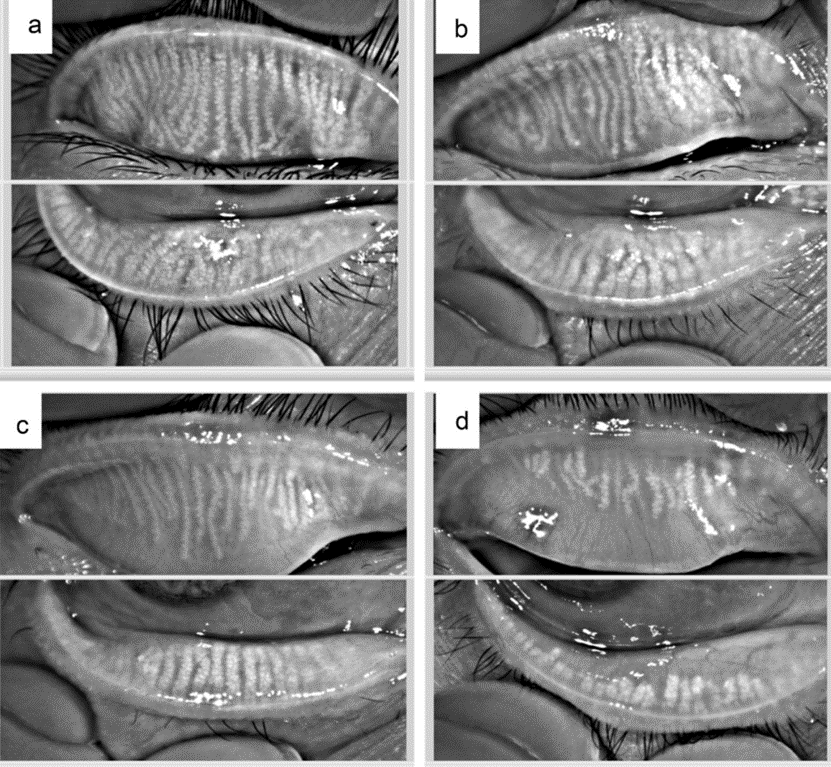 干眼里的"不速之客":眼部蠕形螨_干眼症_干眼症发病原因 - 好大夫在线
