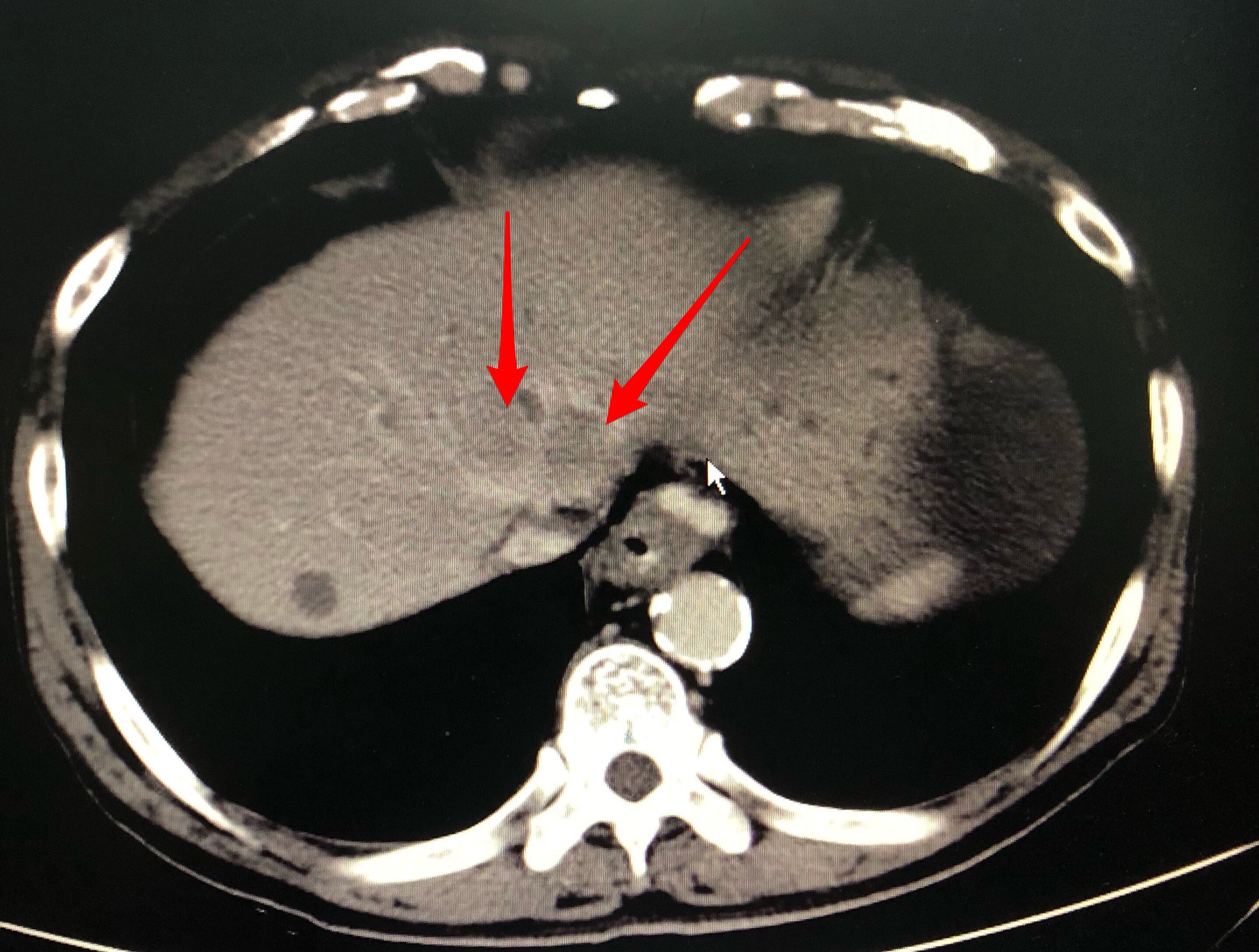 第二肝门ct图片