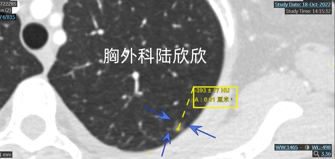 左上1薄层74放大3根小血管CT值.jpg