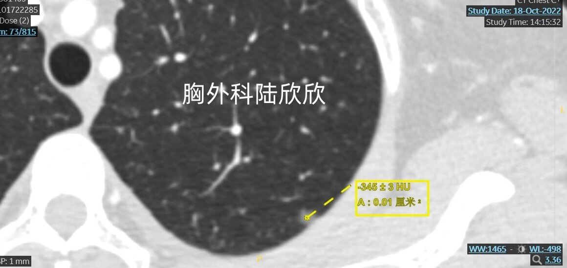 左上1薄层73放大CT值水印.jpg