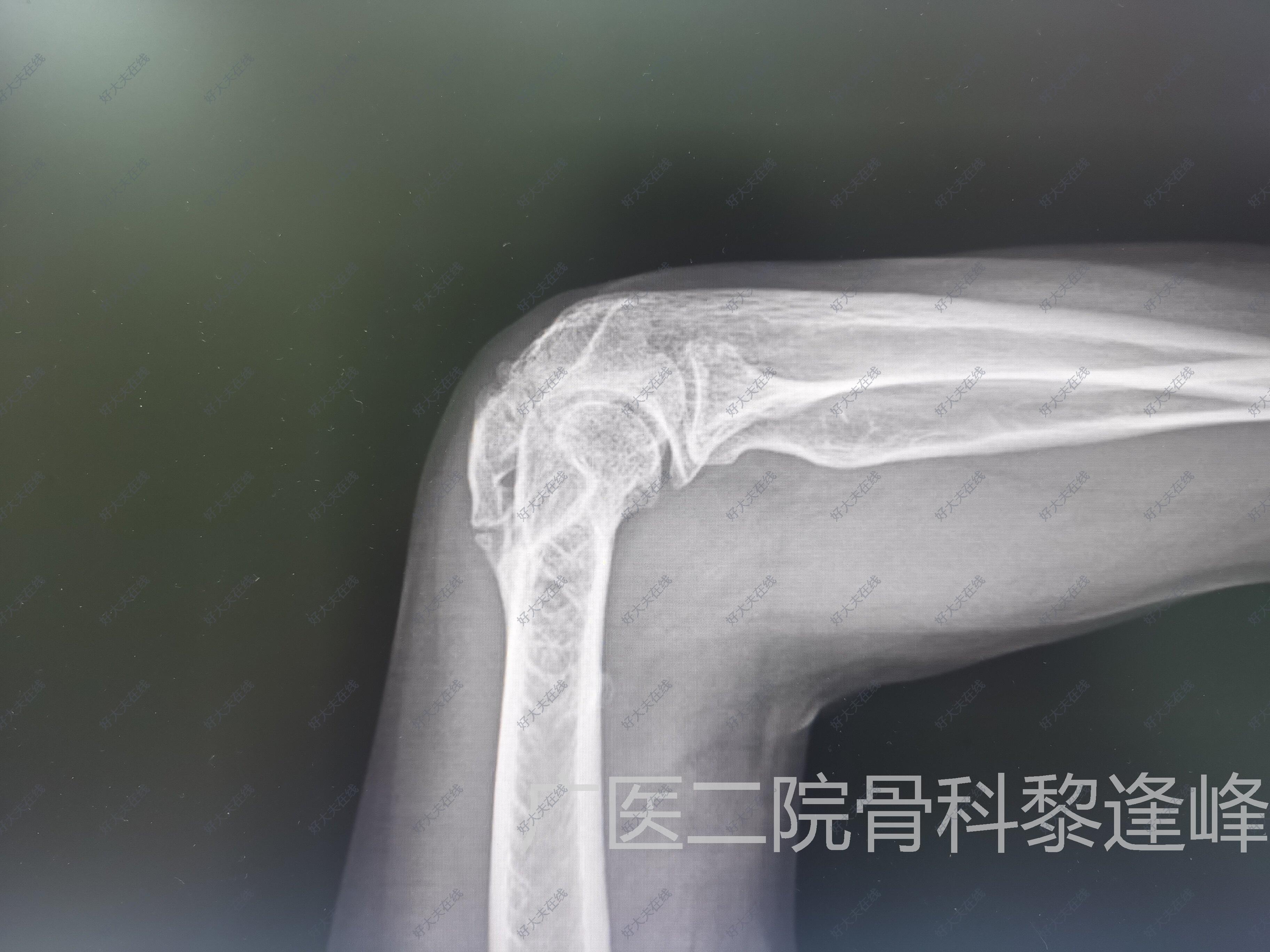 肘关节僵硬 骨折 好大夫在线 肘关节僵硬 骨折 好大夫在线