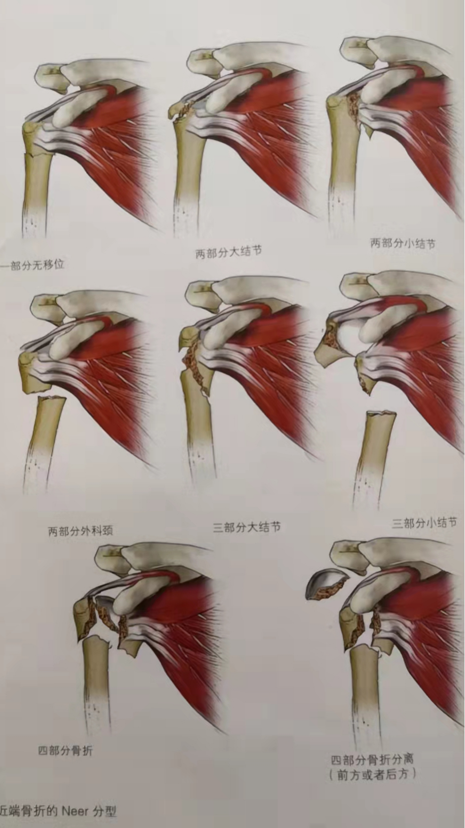 肱骨干骨折分型图片