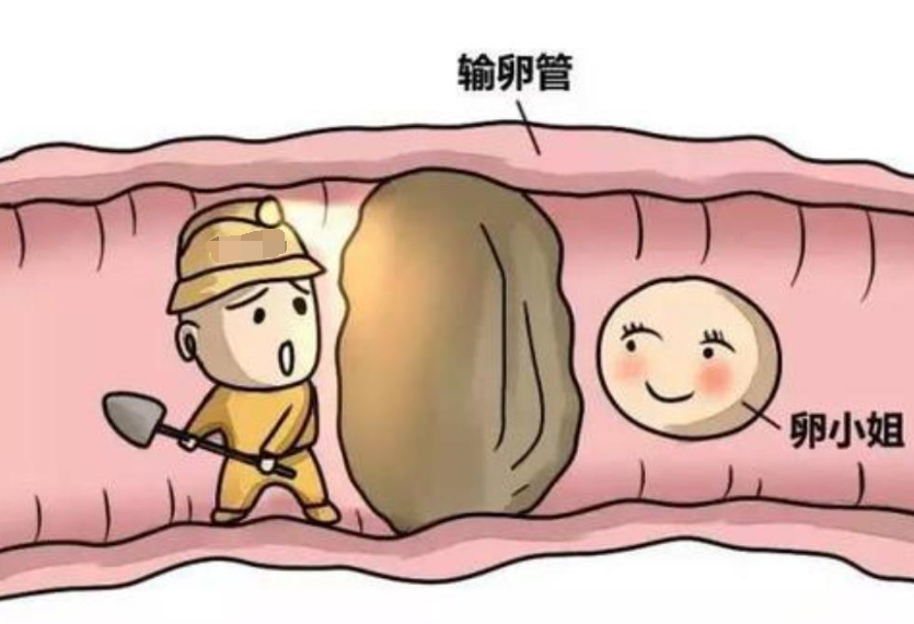 多年不孕的真相可能是你的输卵管堵了……_输卵管堵塞_介绍_治疗方式