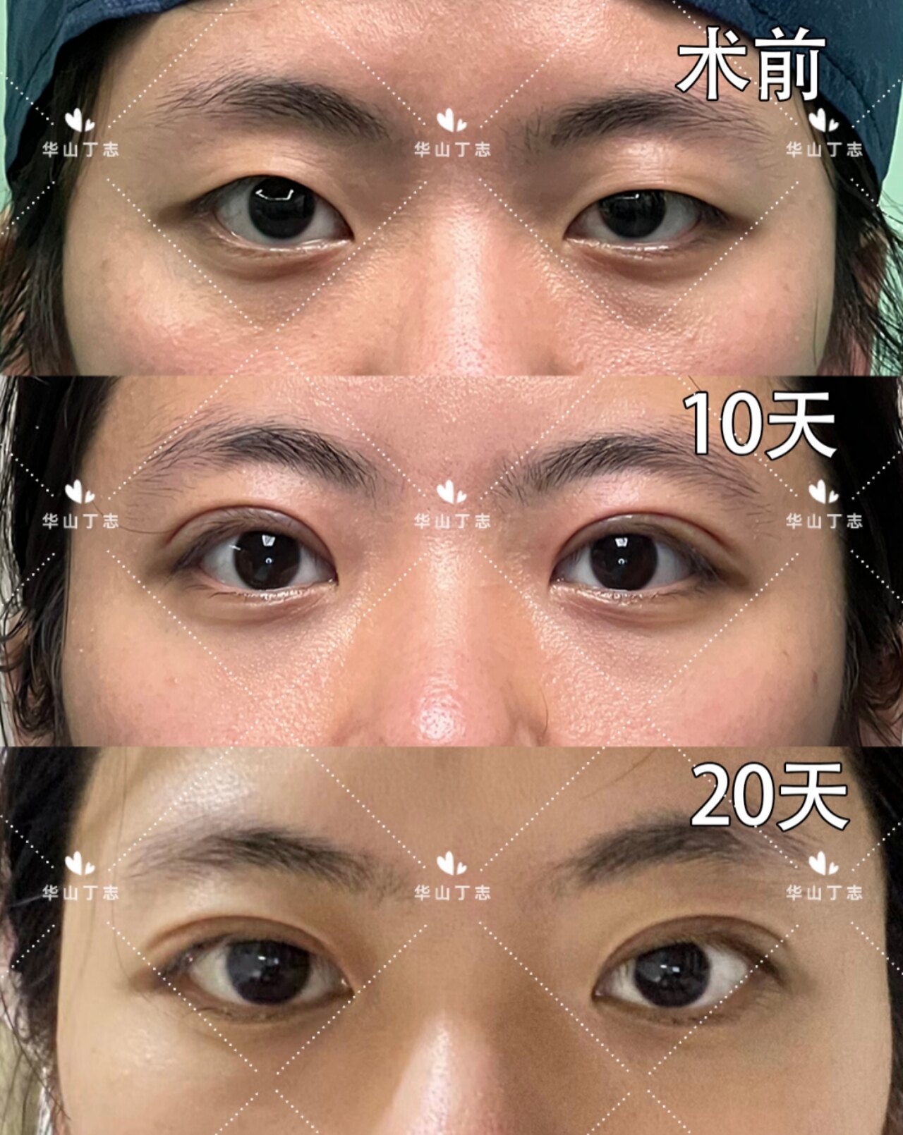 术前分析:突眼,大小眼手术方案:全切双眼皮术后效果:全切双眼皮20天