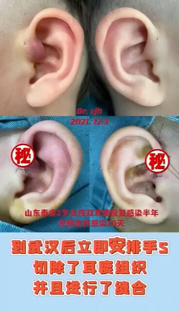 山东泰安小儿耳瘘急性感染到武汉找我治疗