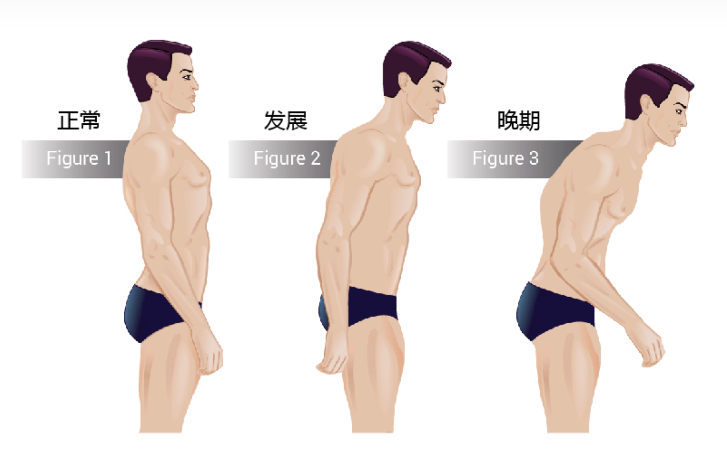 强直性脊柱炎发展过程.png