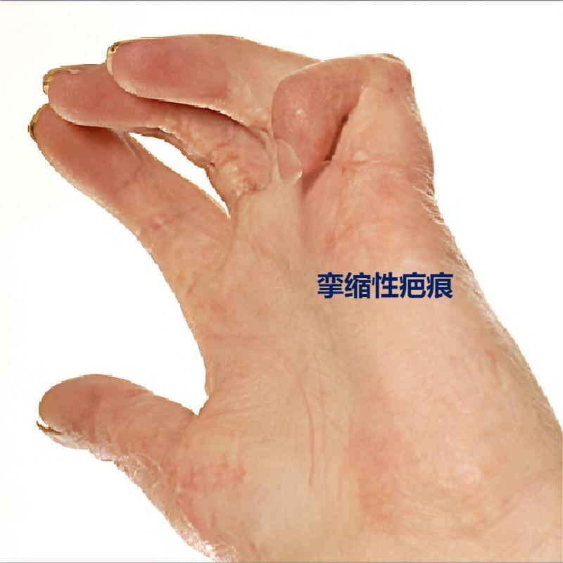 Contracture scars挛缩性疤痕.jpg