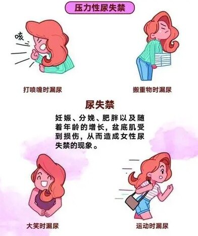 压力性尿失禁PPT图片