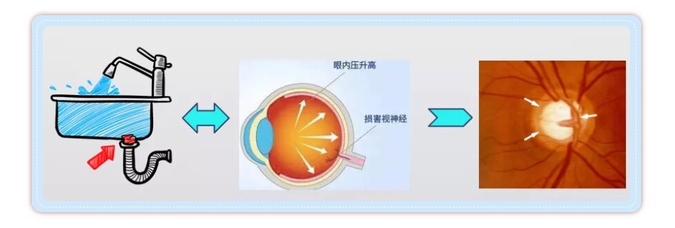 世界青光眼周願所有人都享有看得到的權利