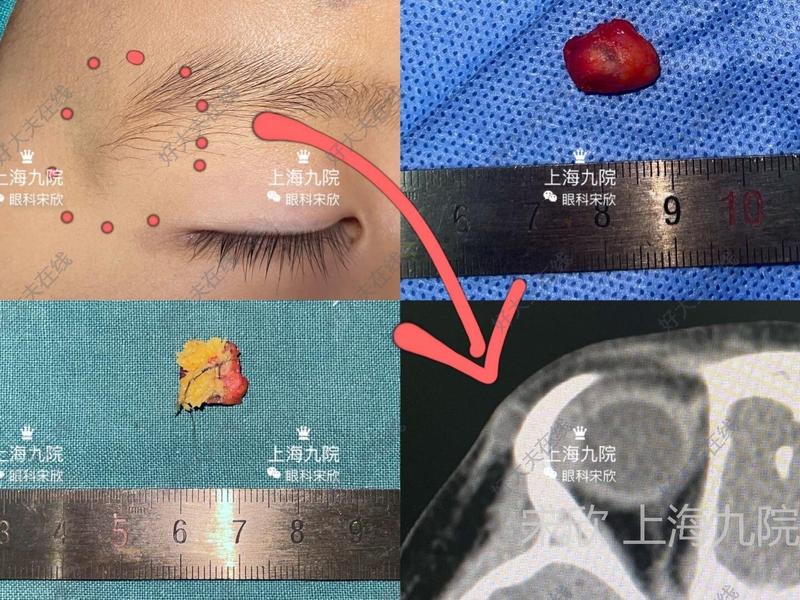 表现:自幼眉毛外侧隆起,随年龄越长越大战胜眼眶囊肿病例系列