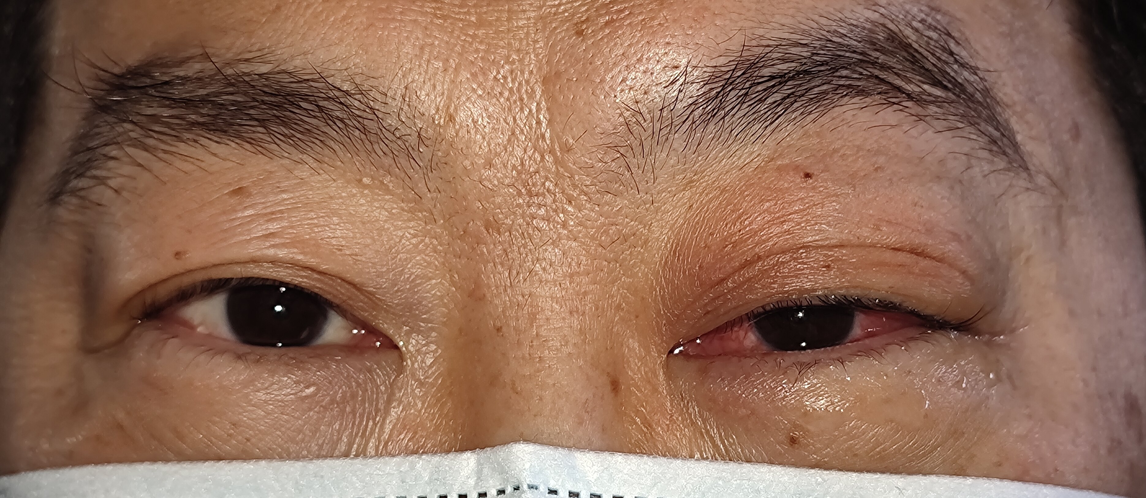 不常见的累及眼球的泪腺炎一例