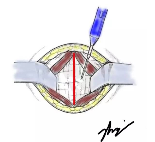 前庭大腺造口术步骤图片