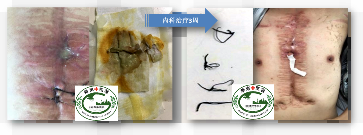 心脏型BS切口流脓17个月.png