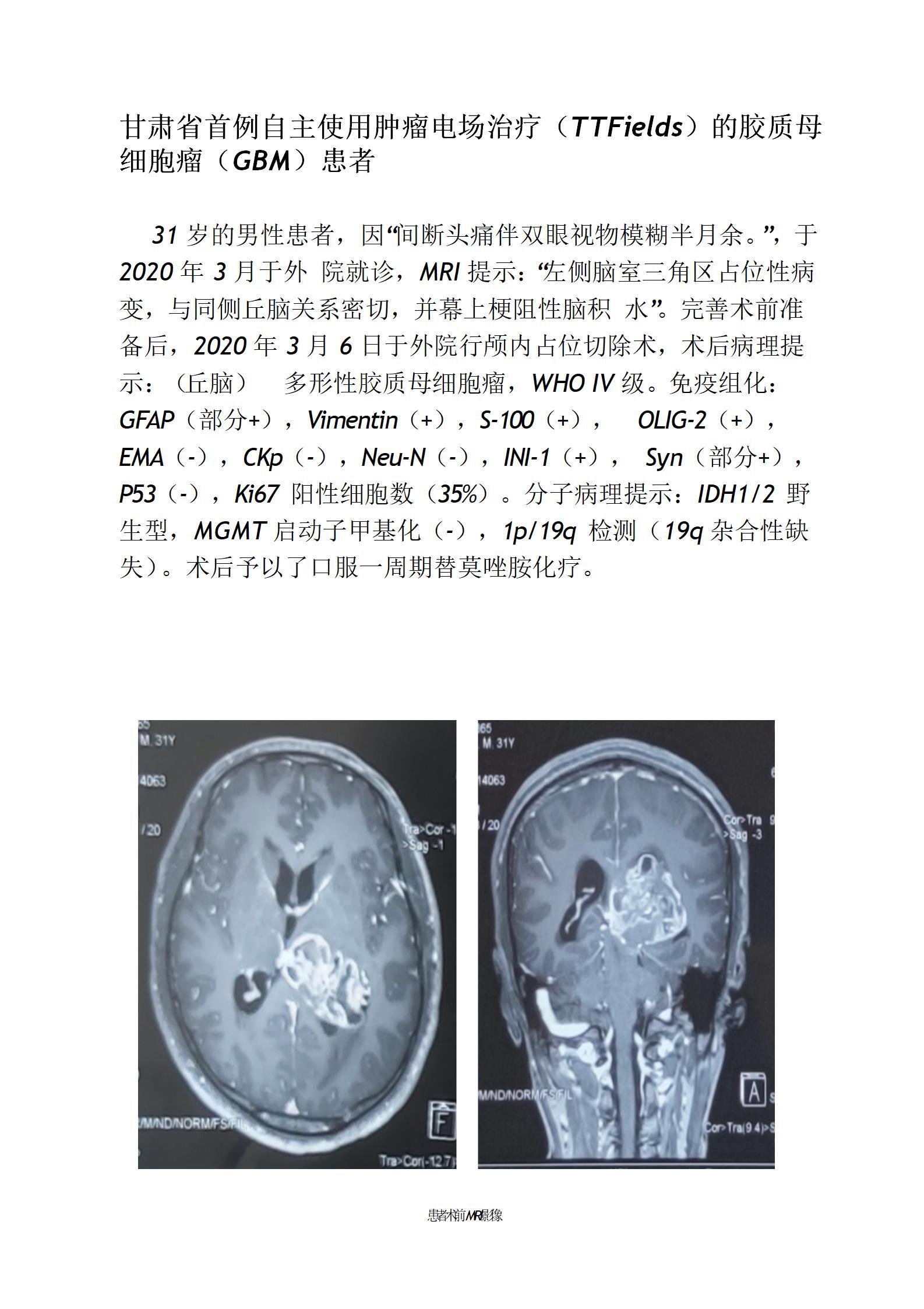 胶质母细胞瘤肿瘤电场治疗(ttfields)1例_胶质瘤_胶质瘤治疗方式 - 好