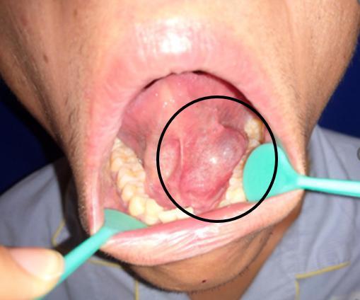 舌下腺囊肿 发炎图片