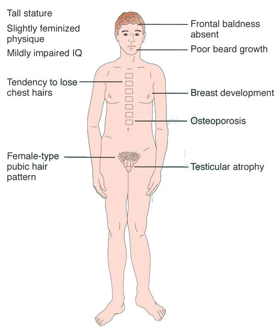 产前诊断发现47 Xxy Klinfelter综合征 怎么办 产前检查 产前检查检查 好大夫在线 产前诊断发现47 Xxy Klinfelter综合征 怎么办 产前检查 产前检查检查 好大夫在线