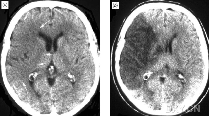 早期缺血性腦卒中ct影象學表現