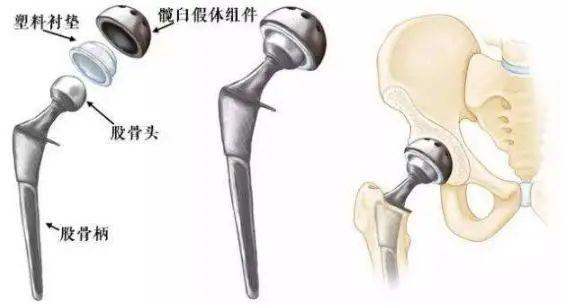 刘欢讲人工髋关节置换图片