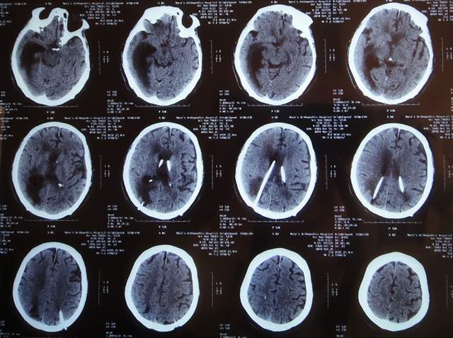 垂體瘤術後腦脊液漏,請北京專家再經鼻補漏後雙眼失明腦積水並顱內