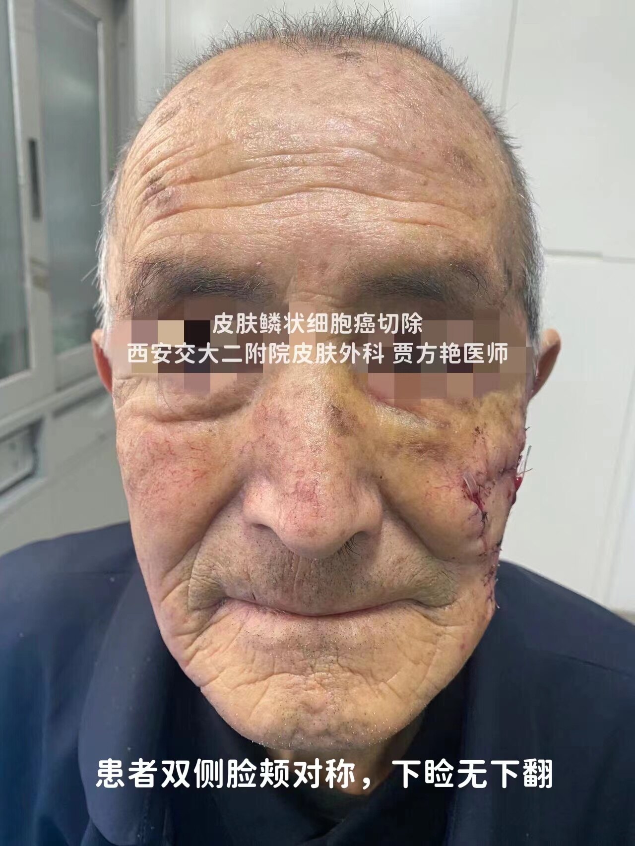 面部鳞状细胞癌手术切除 - 好大夫在线