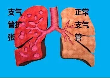 呼吸道感染和支气管阻塞后,反复发生支气管炎症,致使支气管壁结构破坏