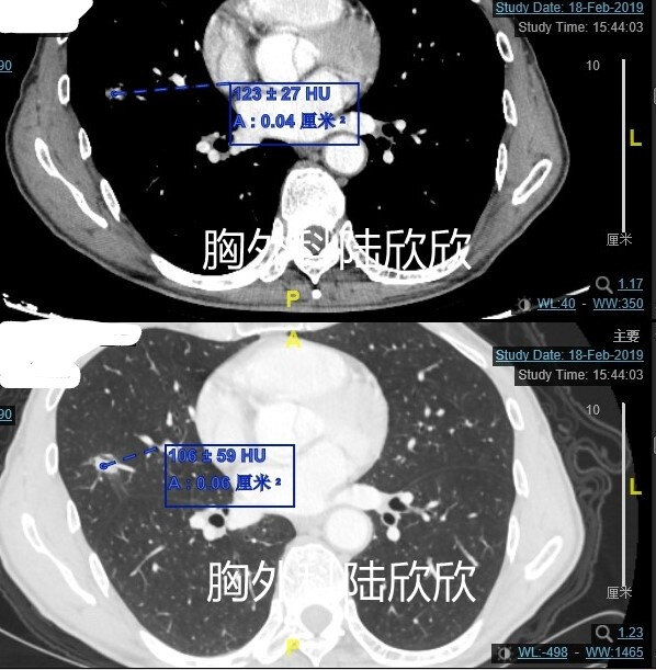 Inked王宏邦右中肺实性结节CT值水印_LI.jpg