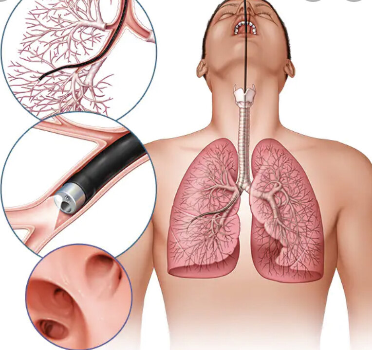 超声支气管镜又是怎么回事儿? - 好大夫在线