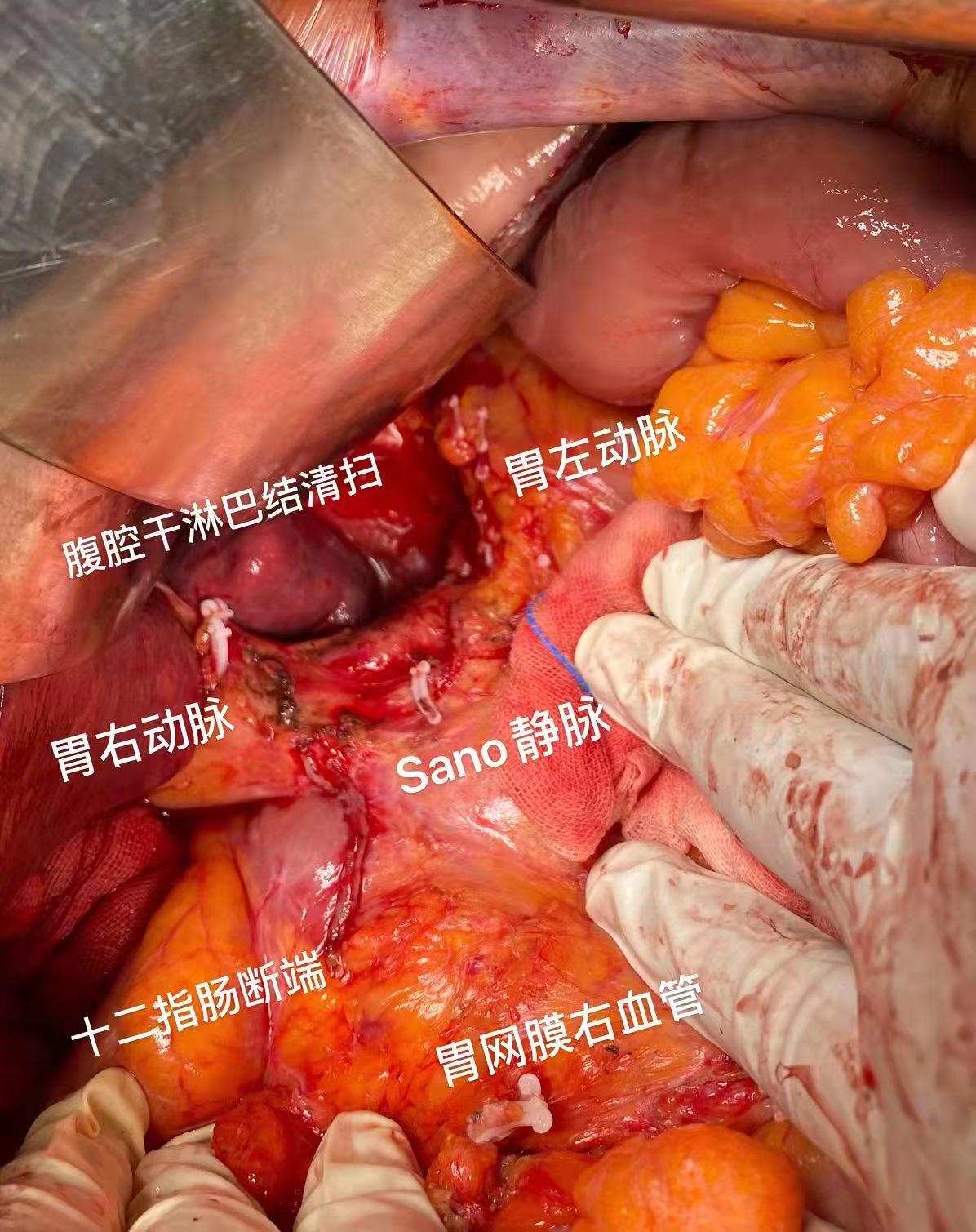 轉化治療守護晚期胃癌患者最後一線生機