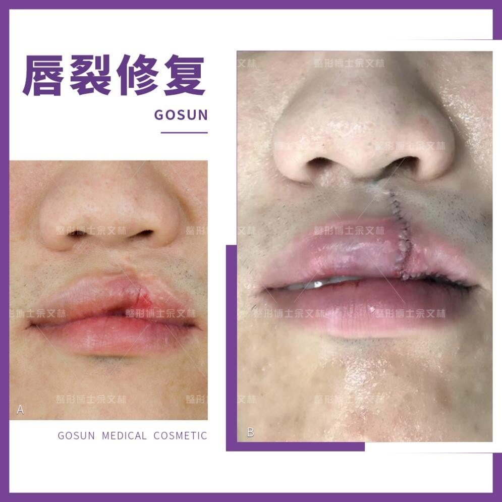 唇裂案例分析