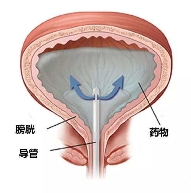 門診膀胱灌注時間調整了