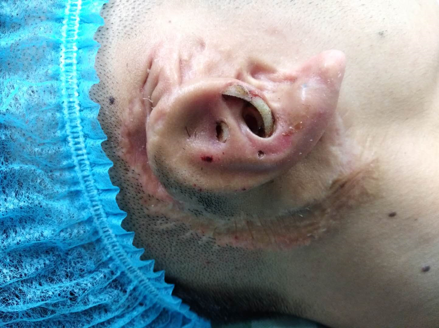 年龄,身体状况等)因为一些因素先天性小耳畸形01是无法用手术恢复耳朵