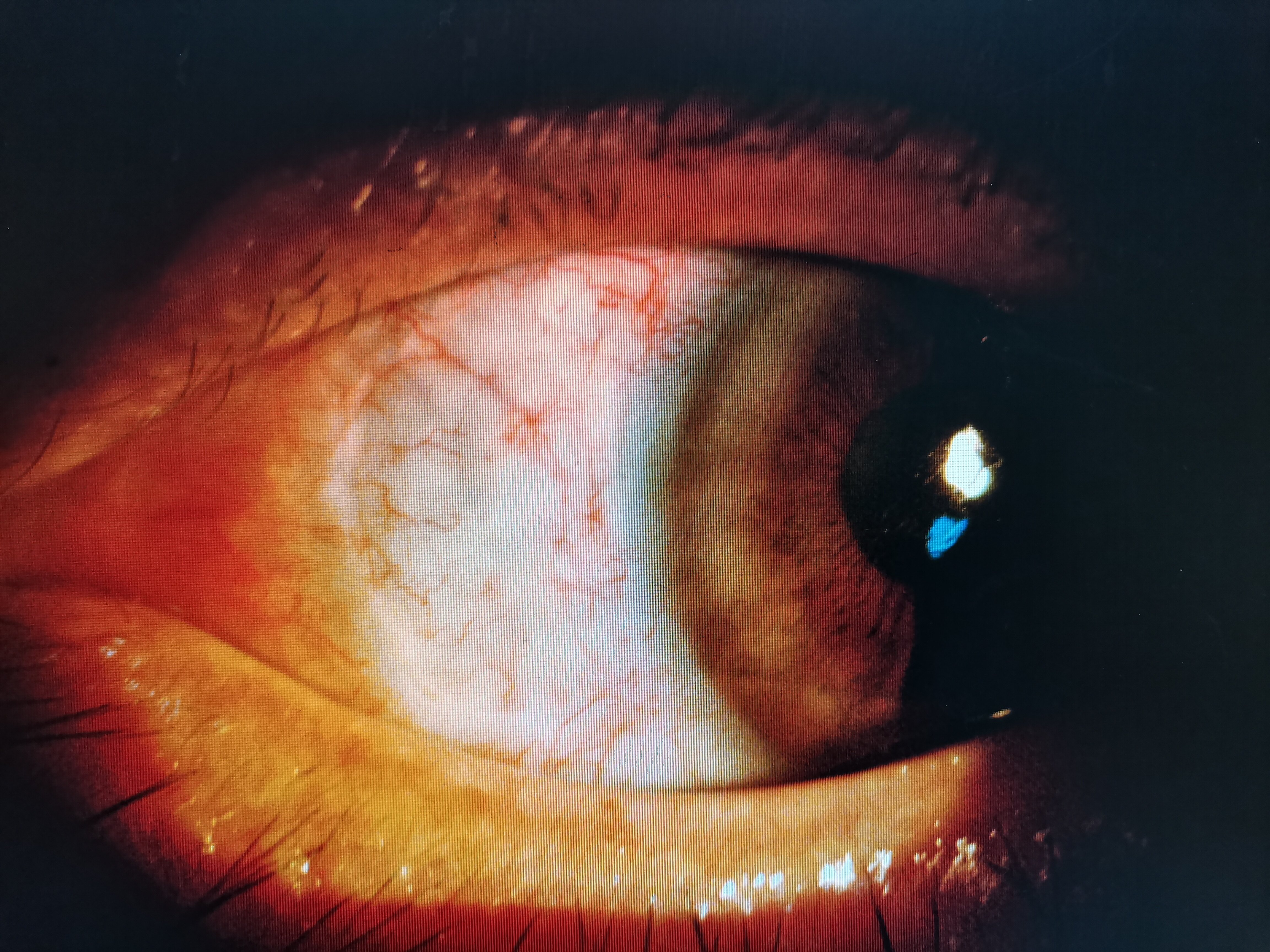 角膜胬肉照片图片