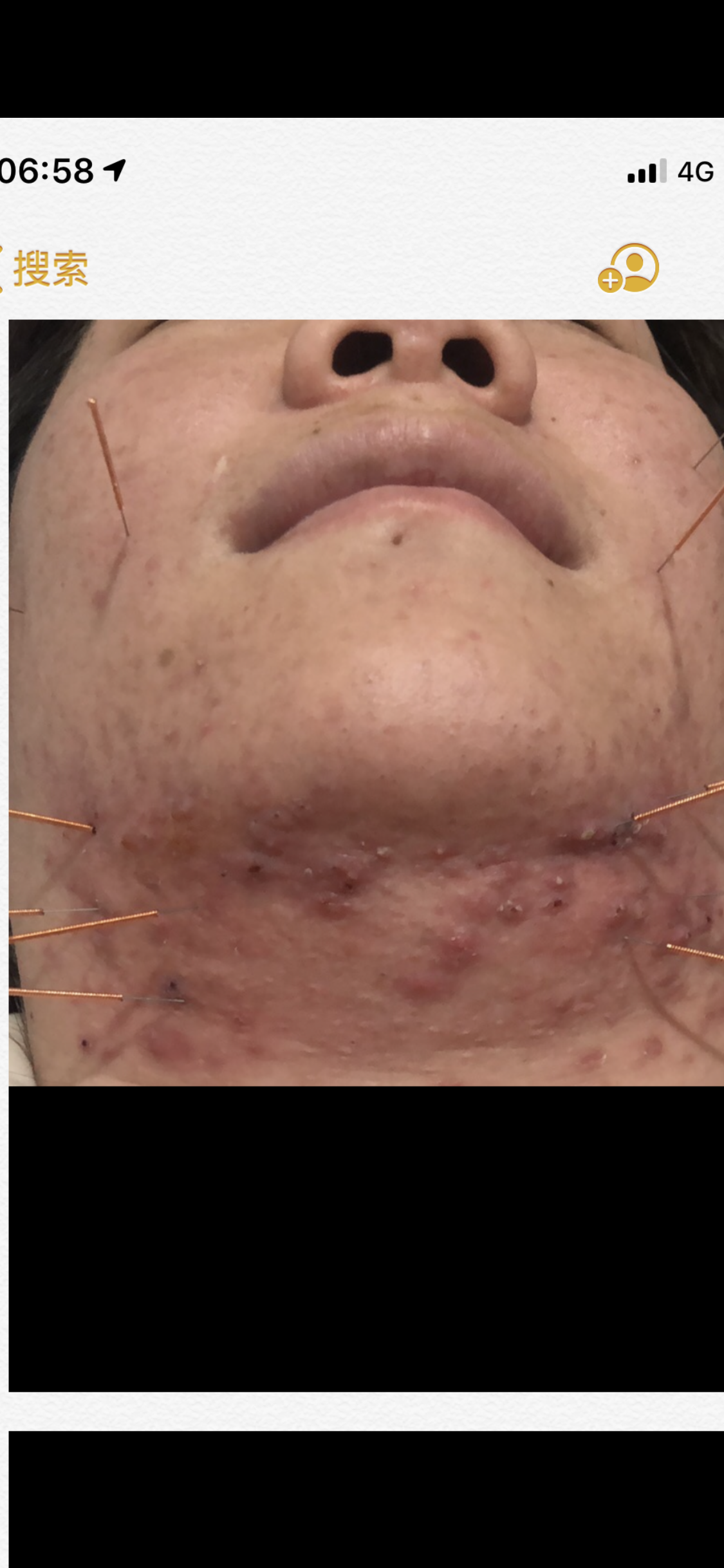 针灸放血调治痤疮是治本之法 - 好大夫在线