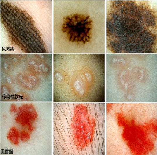 皮肤镜皮肤镜-----皮肤科医生的"第三只眼"_皮肤癌_皮肤癌检查