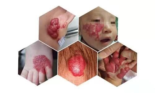 祛除皮肤疤痕疙瘩,婴幼儿血管瘤—核医学科有"神器" - 好大夫在线