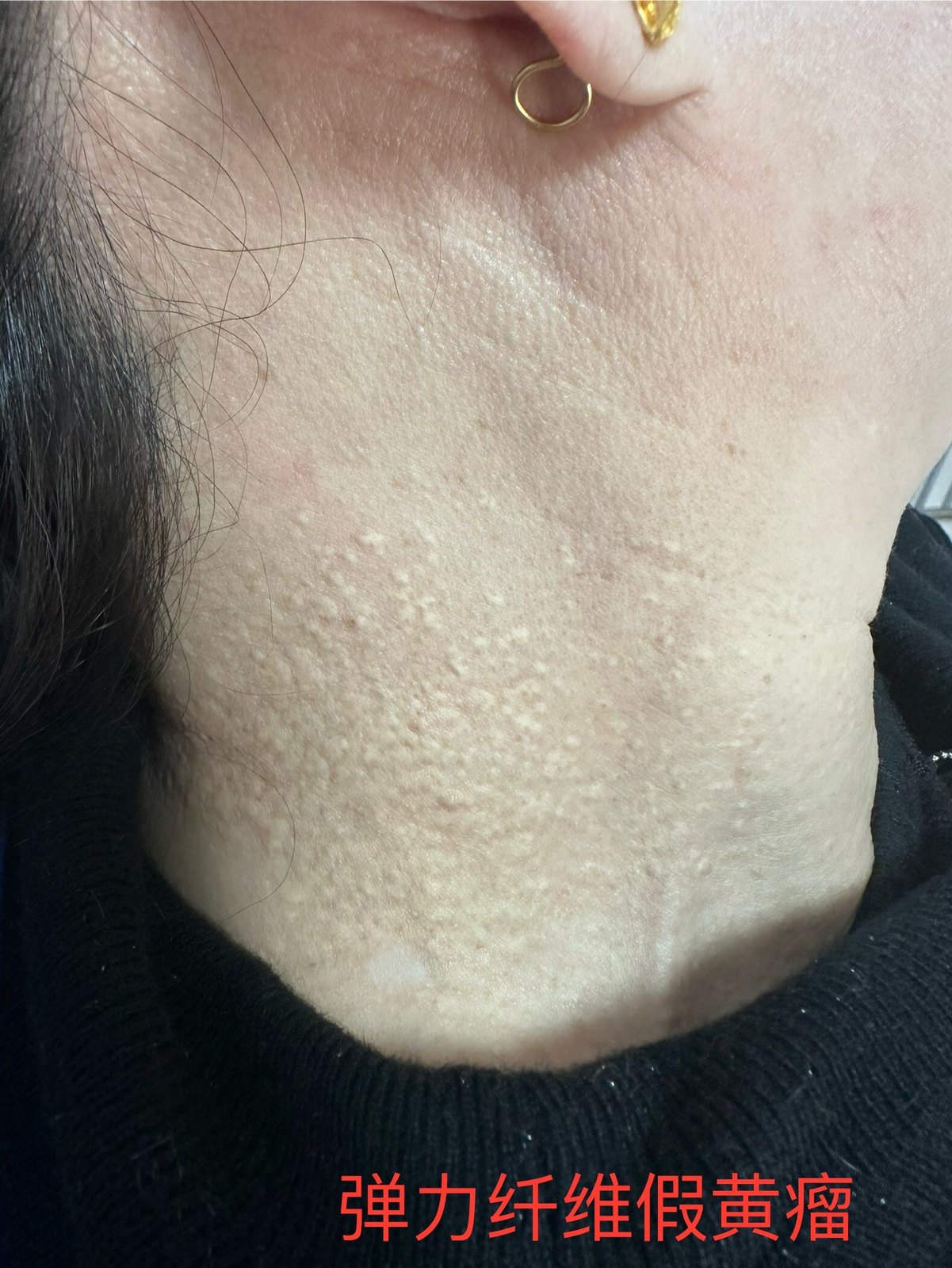 弹力纤维假黄瘤一例