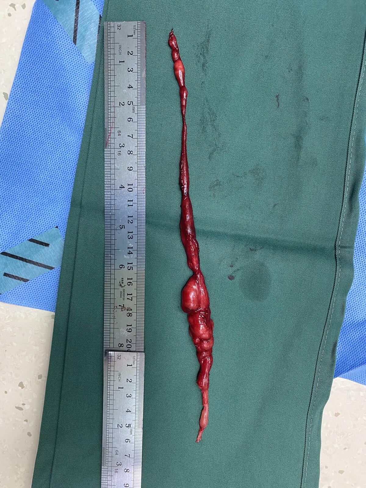 26厘米长神经鞘瘤手术一例 