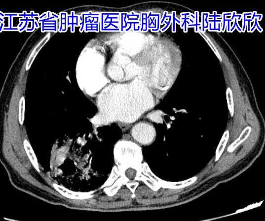 空洞型肿瘤伴肺炎纵隔窗副本.jpg