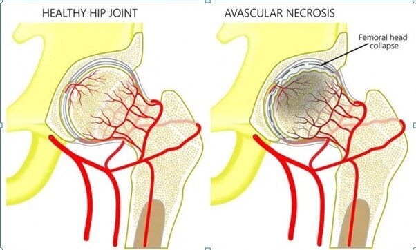 股骨头血供,右侧图示血供减少,股骨头塌陷示意图股骨头早期坏死的保髋