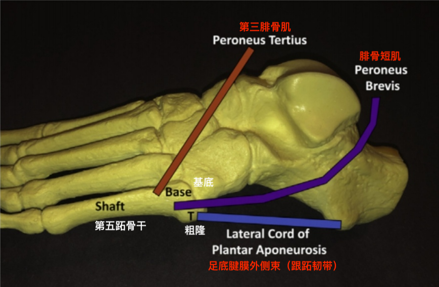 跖骨骨折解剖图图片