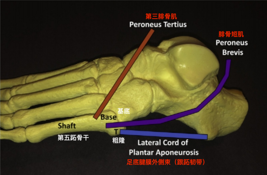 第五跖骨基底部骨折