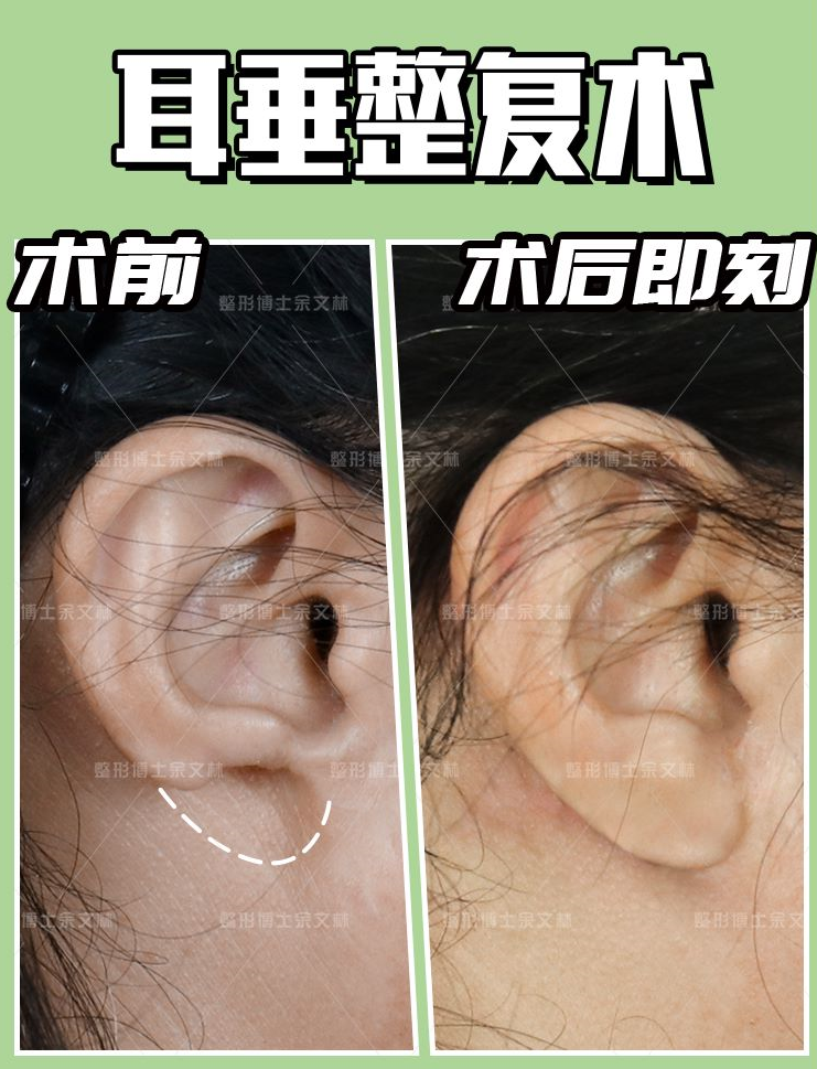 耳整形专家余文林解析:耳垂继续整形的切口在哪里?