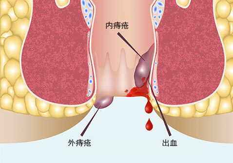 痔疮是怎么得的图片