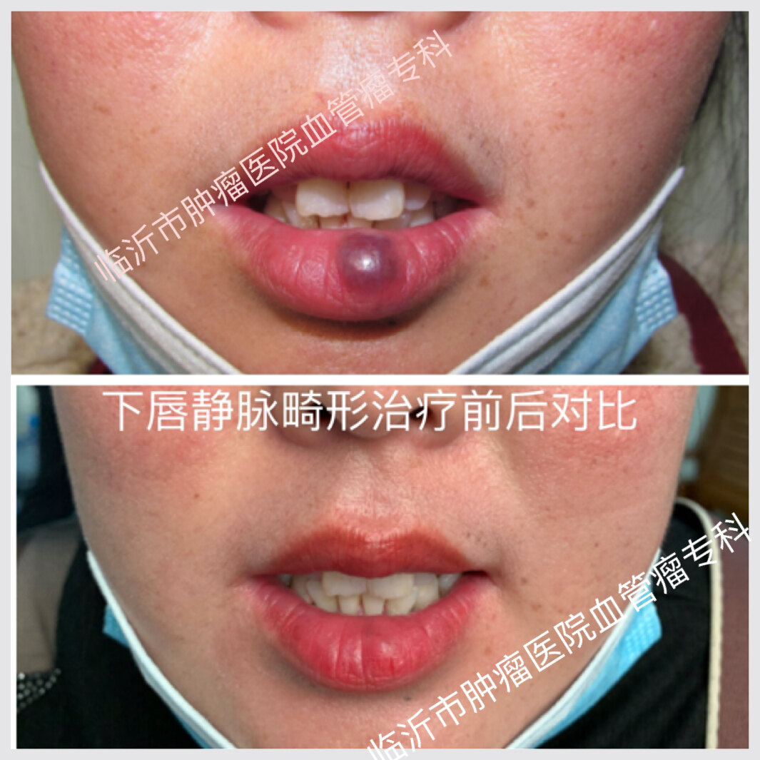 聚桂醇泡沫硬化术在治疗口唇静脉畸形的优势