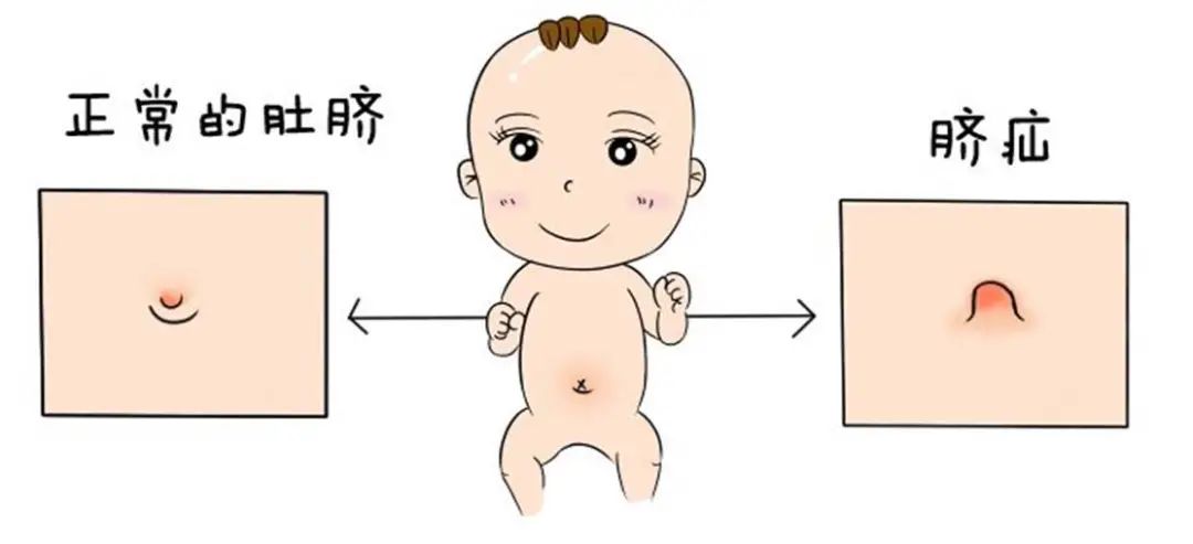 新生儿好发的脐部疾病一二三_新生儿脐炎_新生儿脐炎