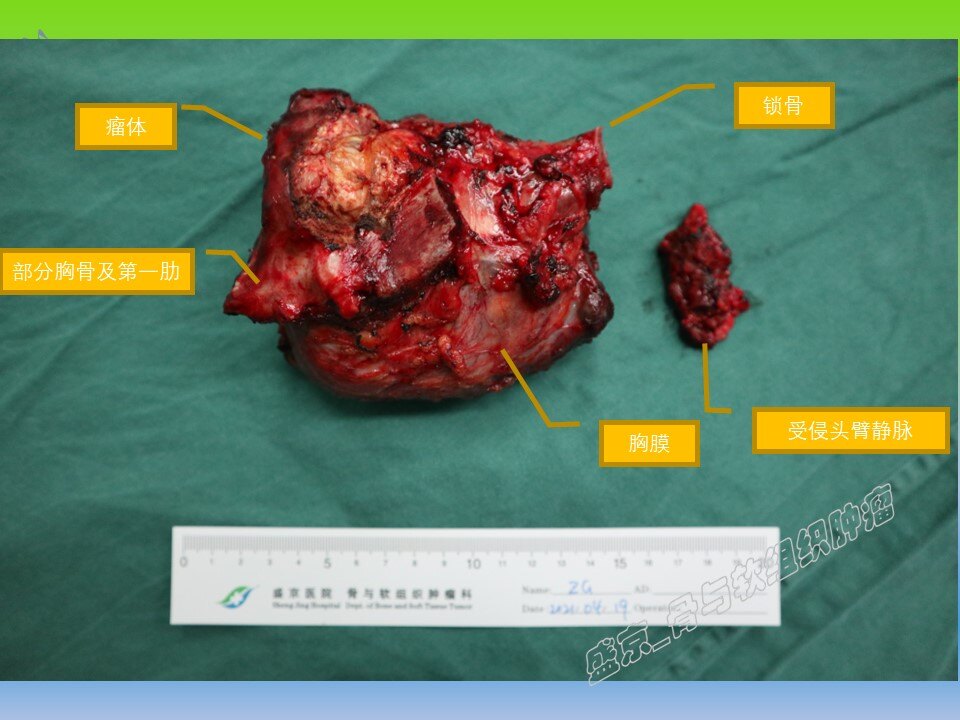 胸锁关节肿瘤图片