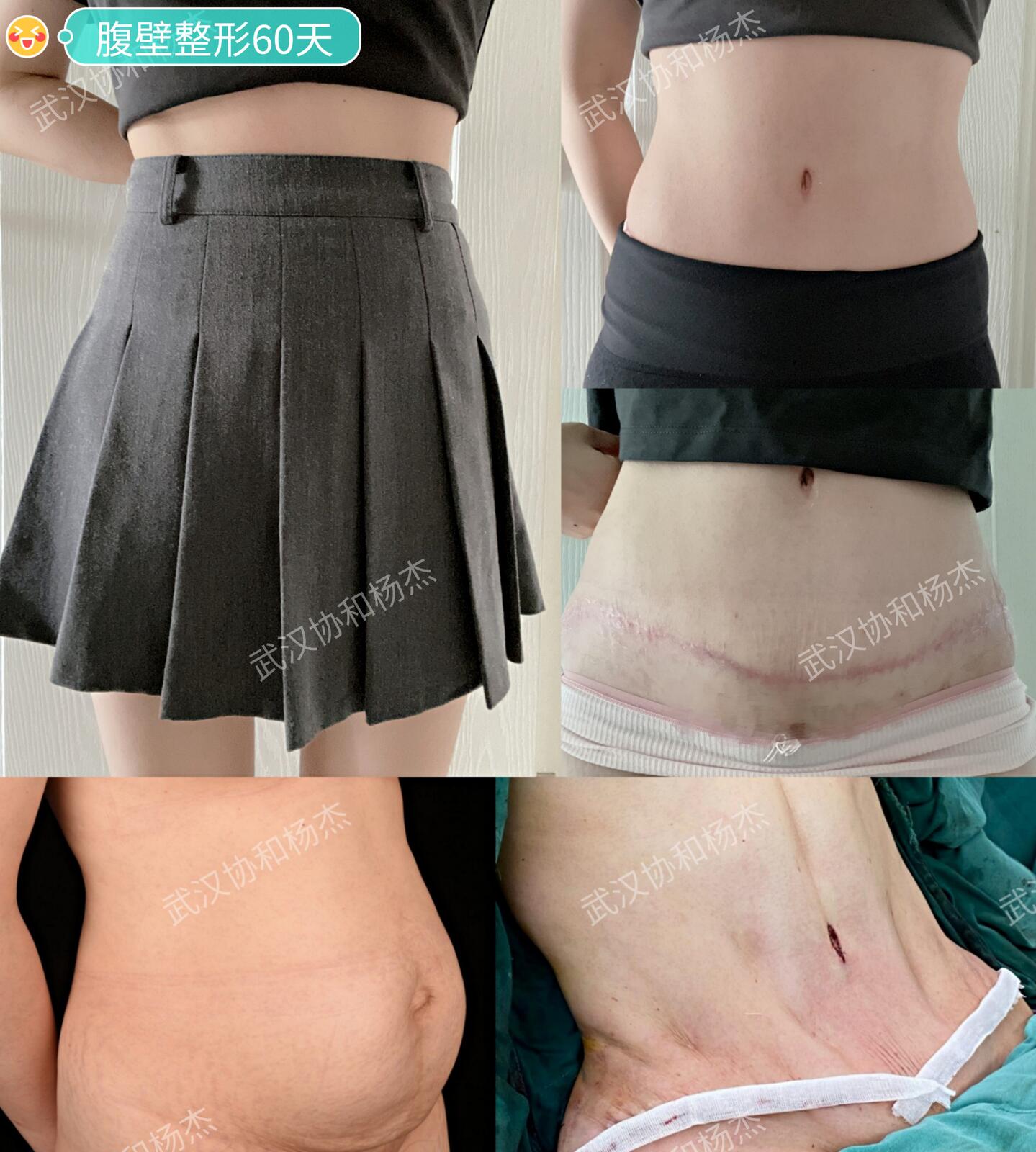 腹壁修复医生夏学颖 案例分享：产后一年做腹直肌矫正术无效后做腹壁成形术 - 知乎